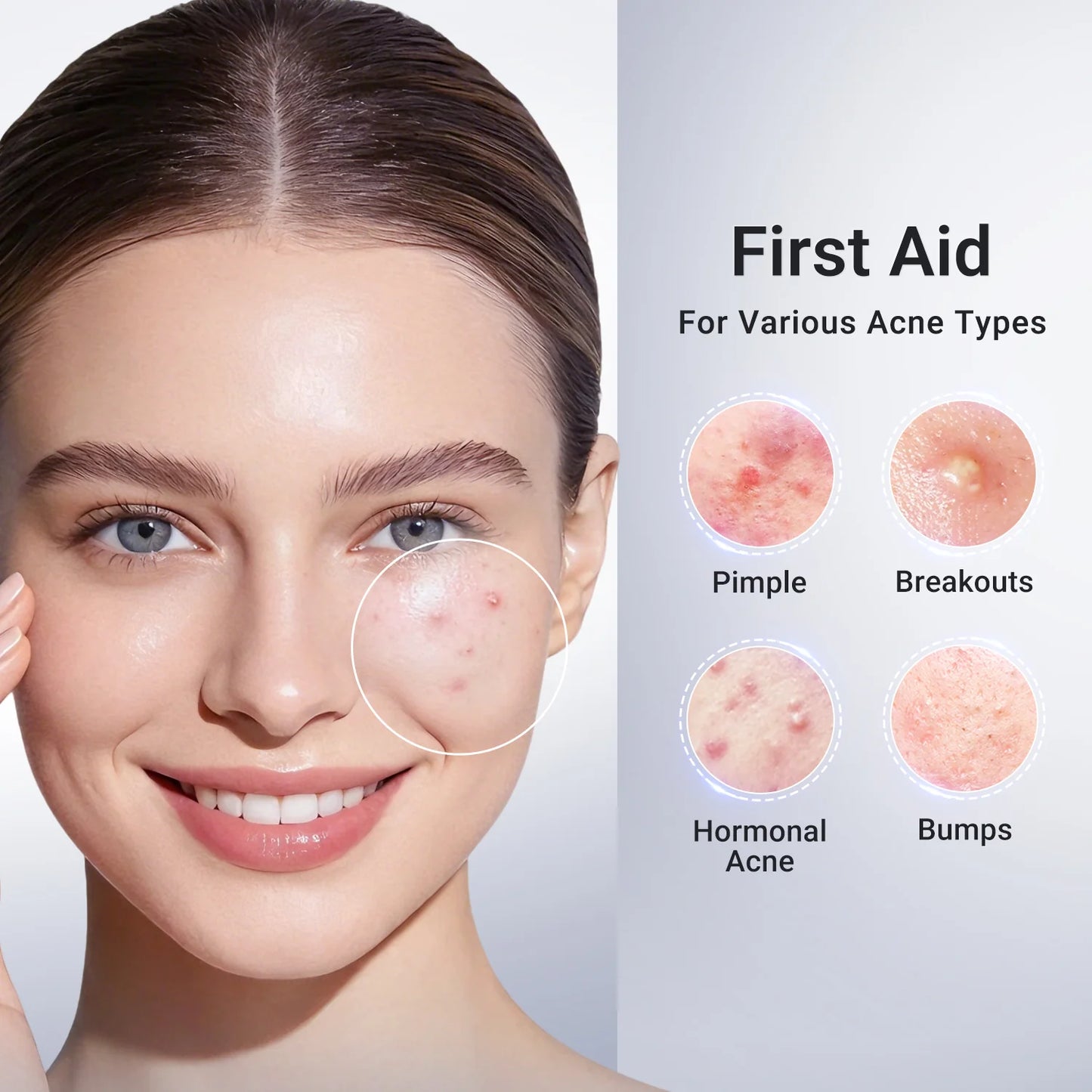 ✔️Maiakoo® Acne Drying Lotion Plus — Get Rid Of Acne Scars In 7 Days💯