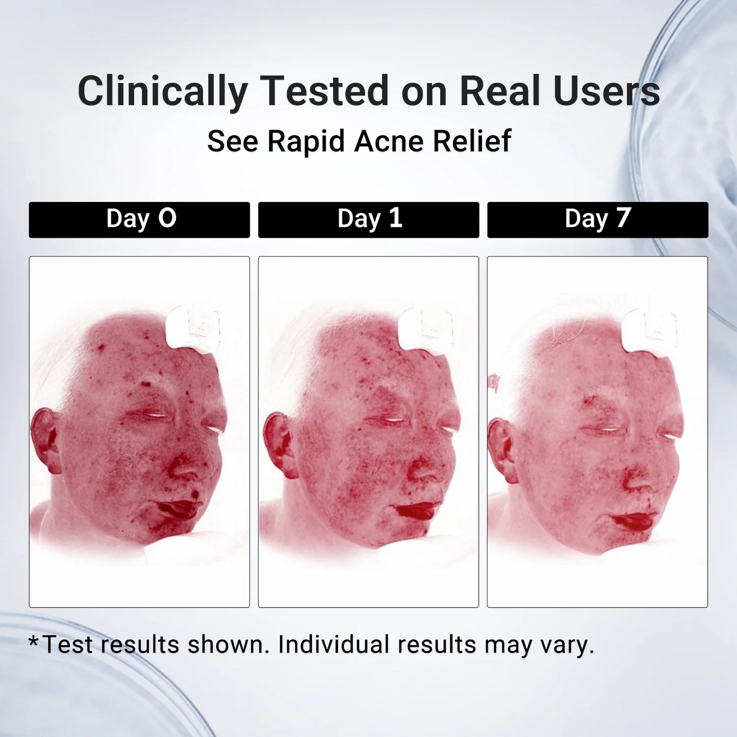 ✔️Maiakoo® Acne Drying Lotion Plus — Get Rid Of Acne Scars In 7 Days💯